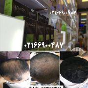 پکیجی قدرتمند برای درمان ریزش مو